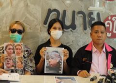 นนทบุรี I สาวร้องทนายดัง หลังถูกถูกหมอศัลยกรรมชื่อดังย่านรัชดาทำจมูก-ใบหน้าพัง ไร้เยียวยา